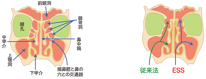 慢性副鼻腔炎（蓄膿症）の手術｜大阪市西区のわたなべ耳鼻咽喉科
