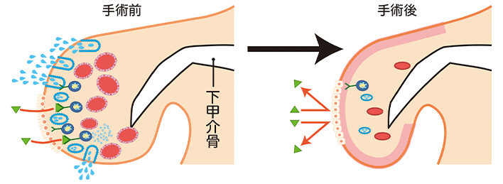 レーザー治療「鼻腔レーザー照射術（下甲介粘膜焼灼術）」