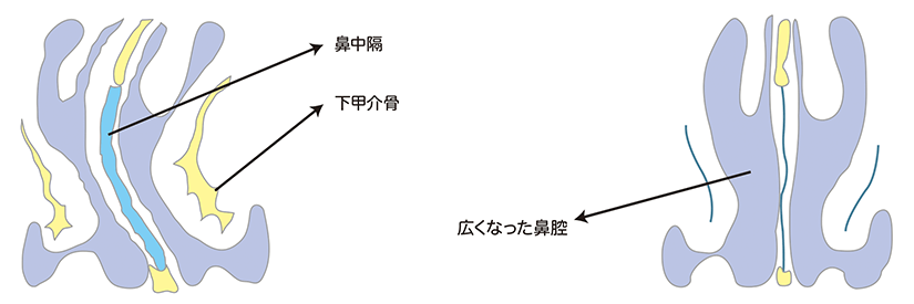 粘膜下下甲介切除術