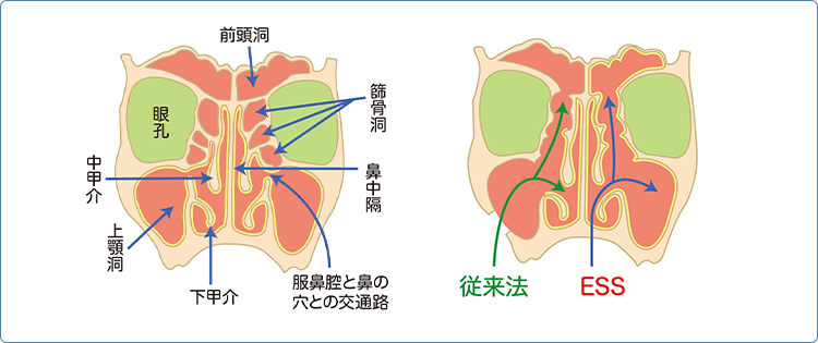 内視鏡下鼻内副鼻腔炎手術（ESS）