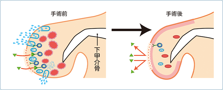 レーザー治療「鼻腔レーザー照射術（下甲介粘膜焼灼術）」