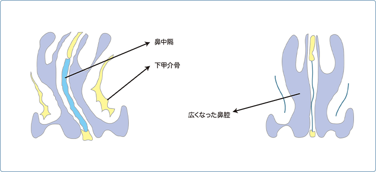 粘膜下下甲介切除術